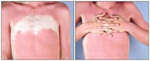 Sunburn