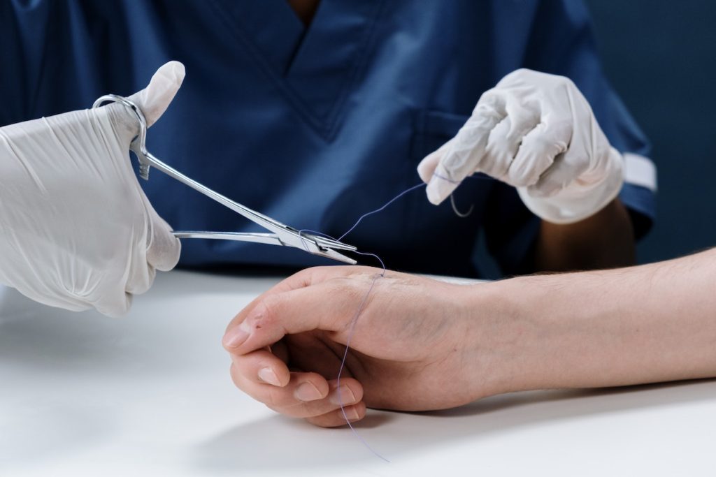 stitches